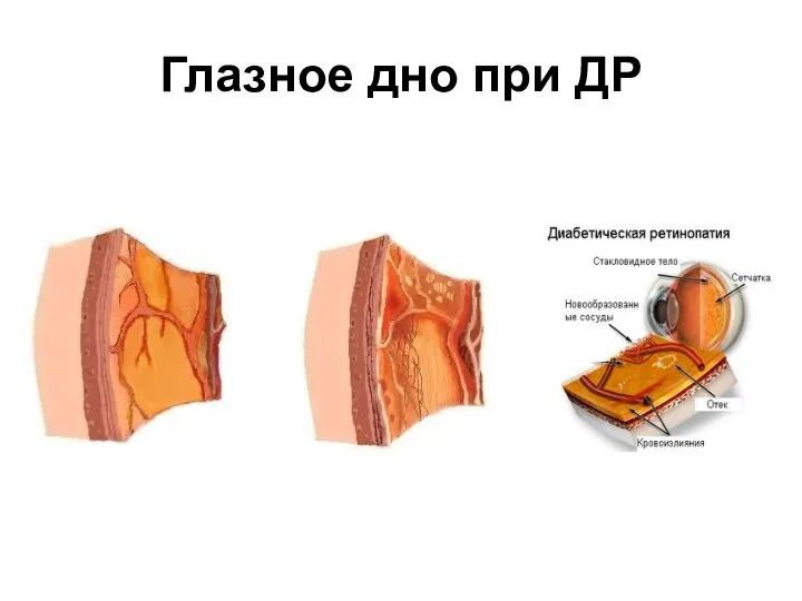 Глазное дно при ДР