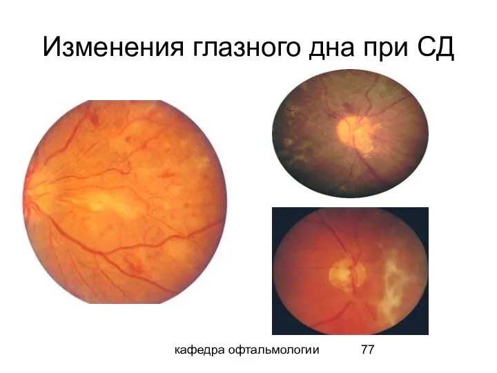 кафедра офтальмологии Изменения глазного дна при СД