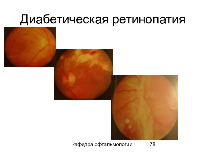 кафедра офтальмологии Диабетическая ретинопатия