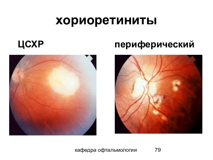 кафедра офтальмологии хориоретиниты ЦСХР периферический