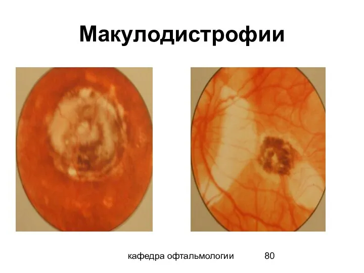 кафедра офтальмологии Макулодистрофии