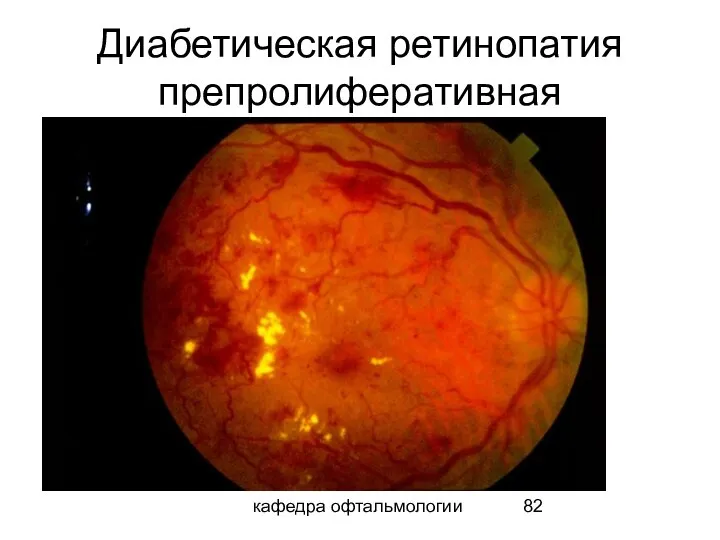 кафедра офтальмологии Диабетическая ретинопатия препролиферативная