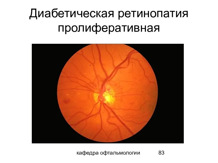 кафедра офтальмологии Диабетическая ретинопатия пролиферативная