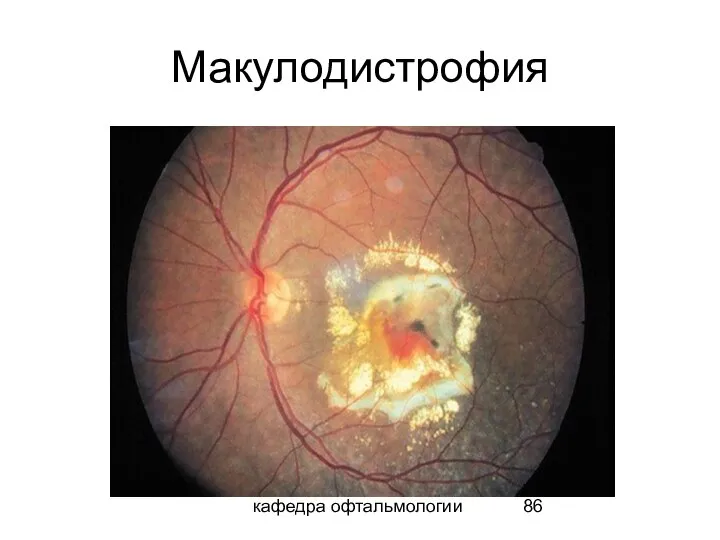 кафедра офтальмологии Макулодистрофия