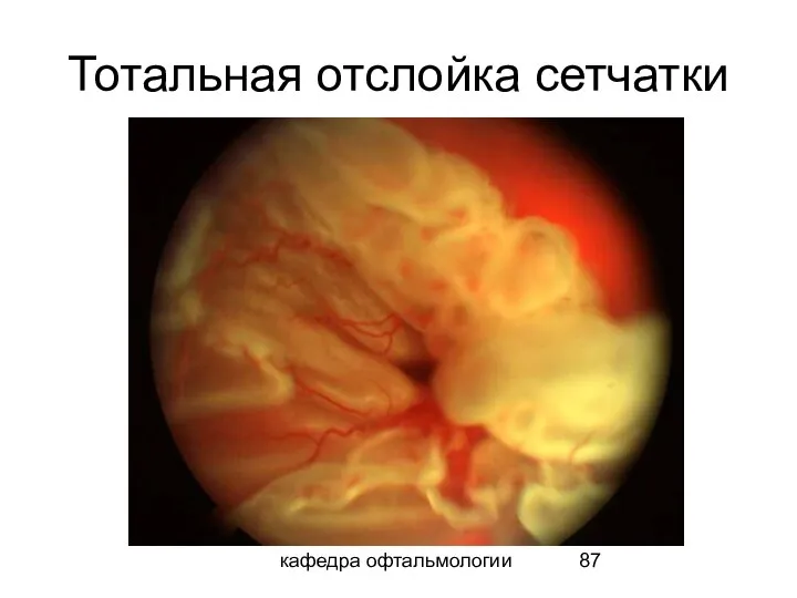 кафедра офтальмологии Тотальная отслойка сетчатки