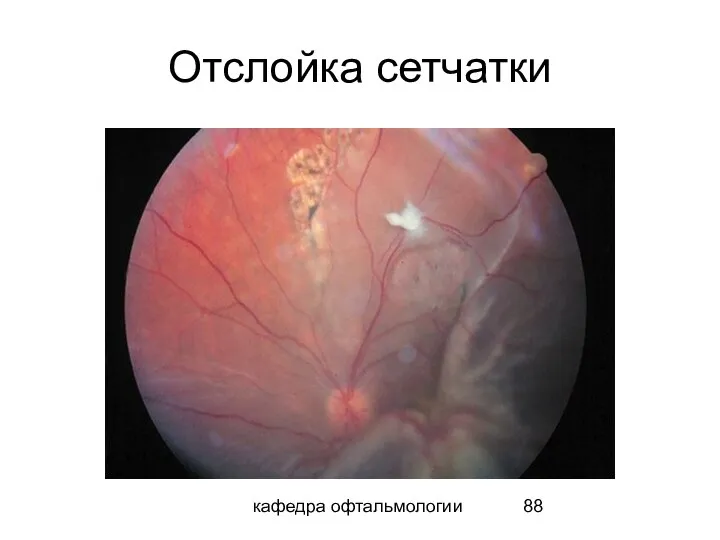 кафедра офтальмологии Отслойка сетчатки