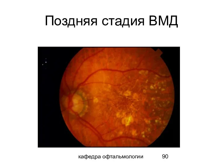 кафедра офтальмологии Поздняя стадия ВМД