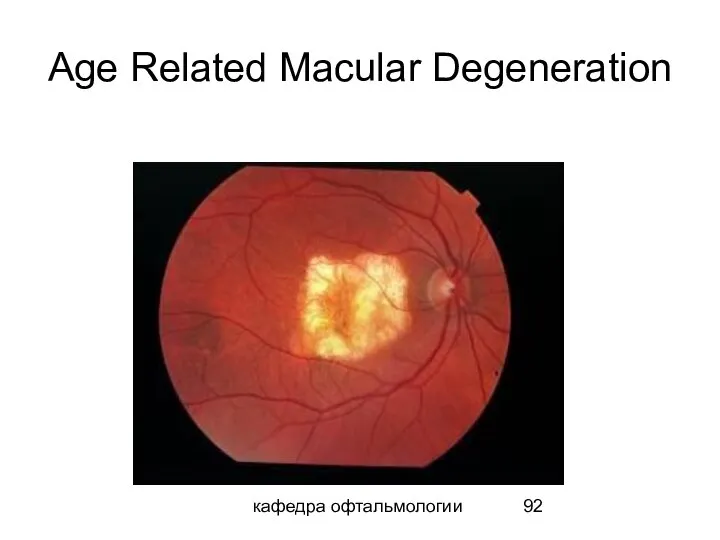 кафедра офтальмологии Age Related Macular Degeneration