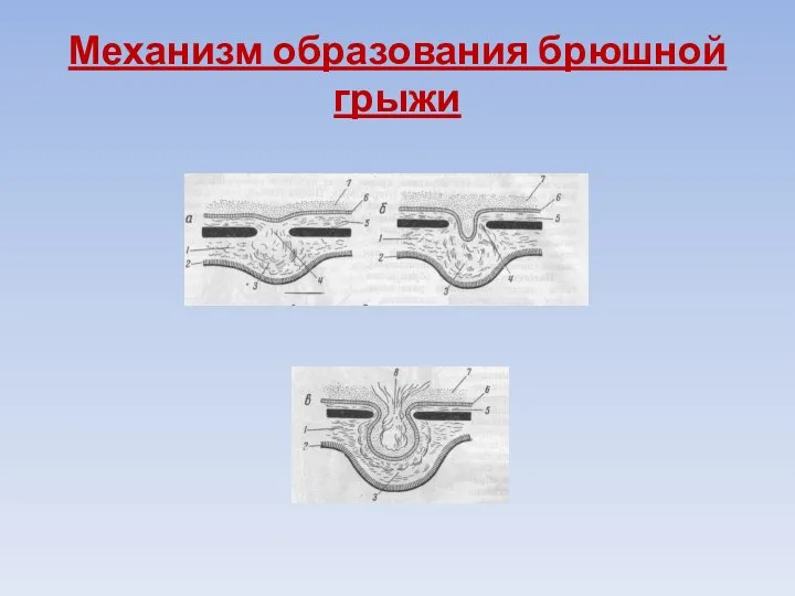 Механизм образования брюшной грыжи