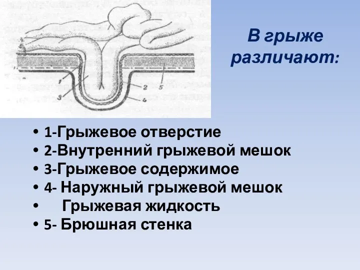 В грыже различают: 1-Грыжевое отверстие 2-Внутренний грыжевой мешок 3-Грыжевое содержимое 4-