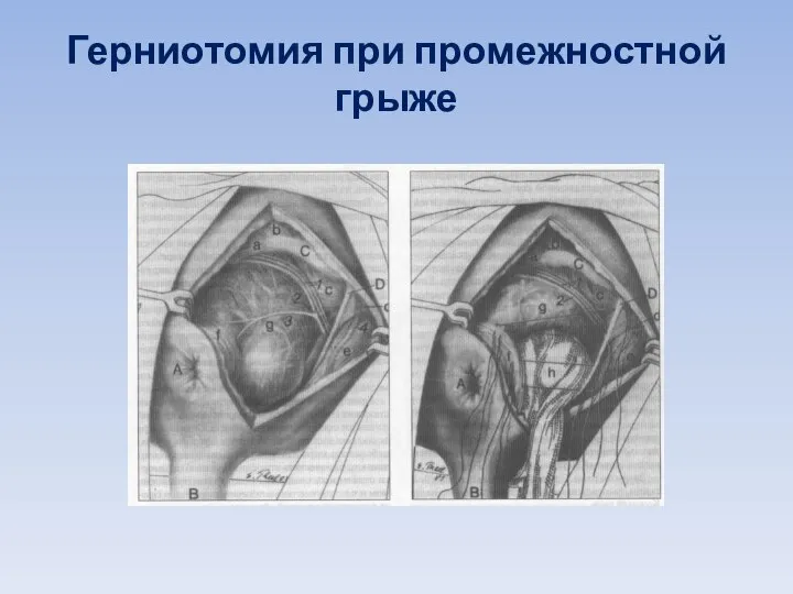 Герниотомия при промежностной грыже