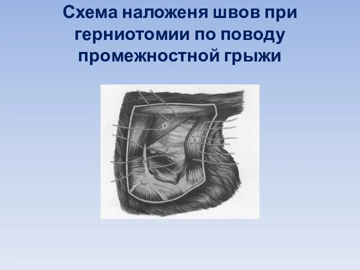 Схема наложеня швов при герниотомии по поводу промежностной грыжи