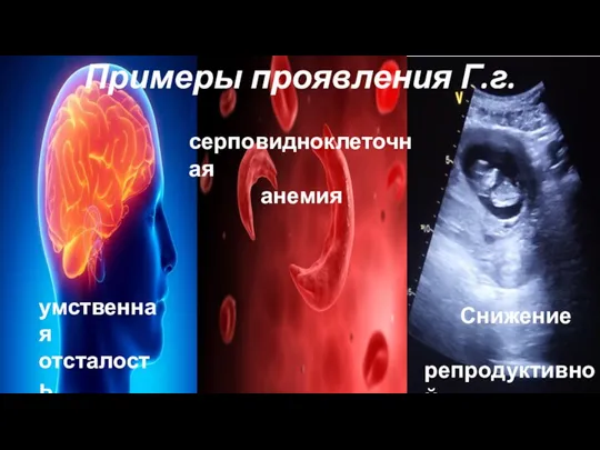 Примеры проявления Г.г. серповидноклеточная анемия умственная отсталость Снижение репродуктивной функции