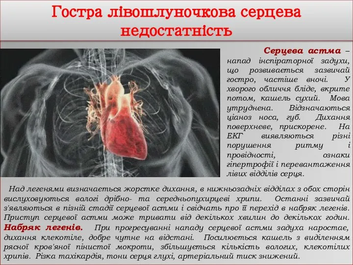 Гостра лівошлуночкова серцева недостатність Серцева астма – напад інспіраторної задухи, що