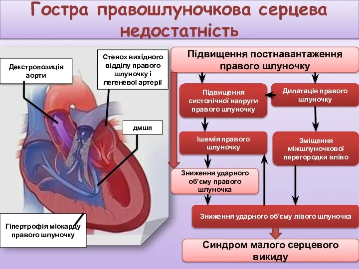 Гостра правошлуночкова серцева недостатність Підвищення постнавантаження правого шлуночку Підвищення систолічної напруги