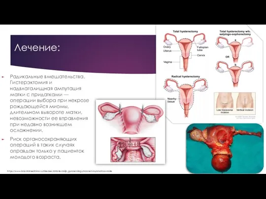 Лечение: Радикальные вмешательства. Гистерэктомия и надвлагалищная ампутация матки с придатками —