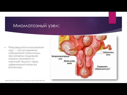 Миоматозный узел: Рождающийся миоматозный узел — это осложнение субмукозной лейомиомы, при