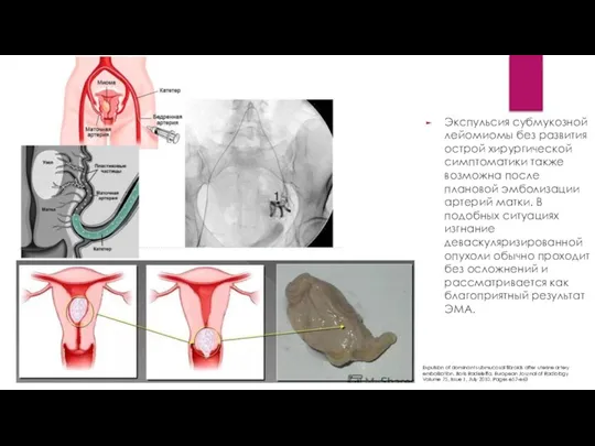 Экспульсия субмукозной лейомиомы без развития острой хирургической симптоматики также возможна после