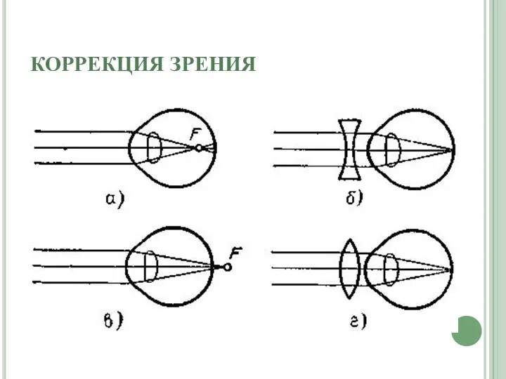 КОРРЕКЦИЯ ЗРЕНИЯ