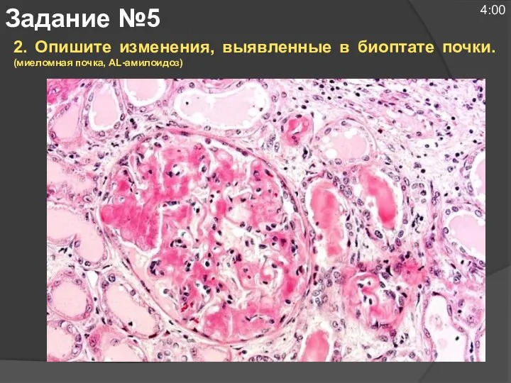 2. Опишите изменения, выявленные в биоптате почки. (миеломная почка, AL-амилоидоз) Задание №5 4:00