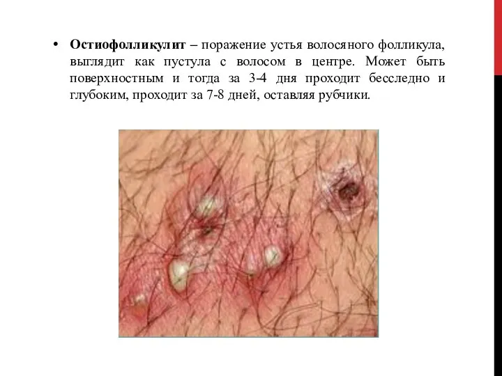 Остиофолликулит – поражение устья волосяного фолликула, выглядит как пустула с волосом