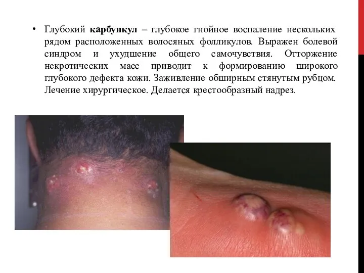 Глубокий карбункул – глубокое гнойное воспаление нескольких рядом расположенных волосяных фолликулов.