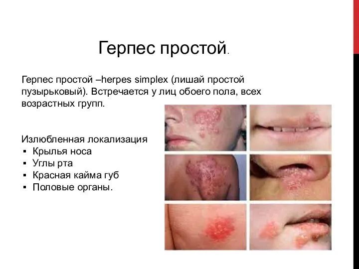 Герпес простой. Герпес простой –herpes simplex (лишай простой пузырьковый). Встречается у