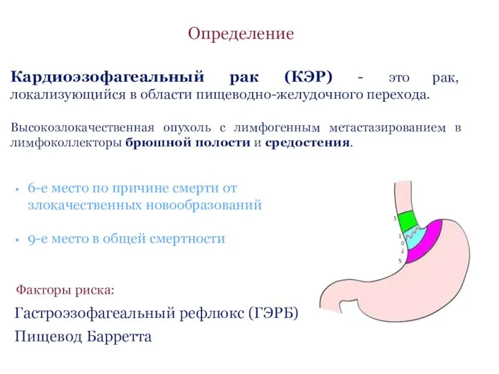 Определение Кардиоэзофагеальный рак (КЭР) - это рак, локализующийся в области пищеводно-желудочного