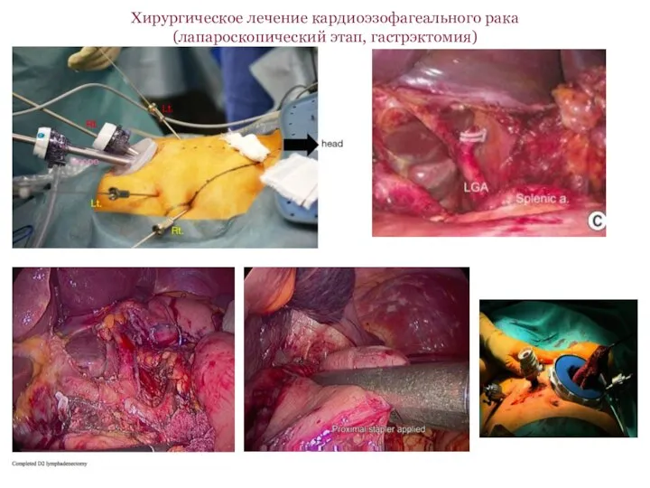 Хирургическое лечение кардиоэзофагеального рака (лапароскопический этап, гастрэктомия)
