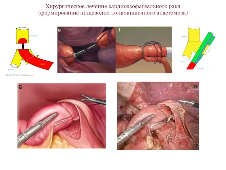 Хирургическое лечение кардиоэзофагеального рака (формирование пищеводно-тонкокишечного анастомоза)