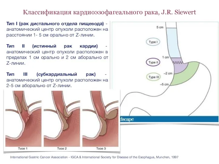 Классификация кардиоэзофагеального рака, J.R. Siewert Тип I (рак дистального отдела пищевода)