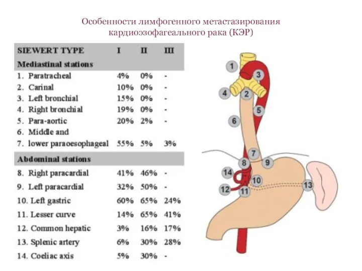 Особенности лимфогенного метастазирования кардиоэзофагеального рака (КЭР)