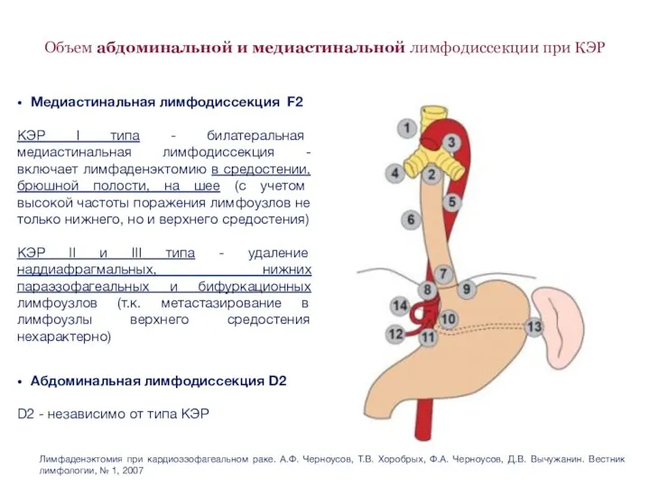 Объем абдоминальной и медиастинальной лимфодиссекции при КЭР Абдоминальная лимфодиссекция D2 D2