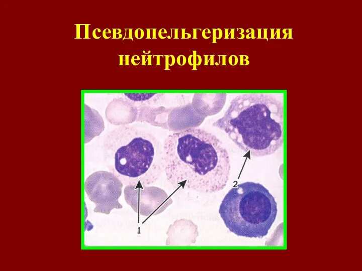 Псевдопельгеризация нейтрофилов