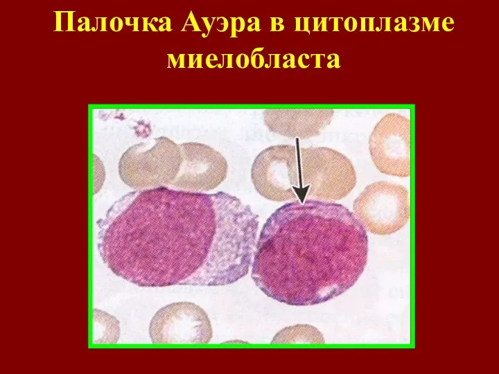 Палочка Ауэра в цитоплазме миелобласта