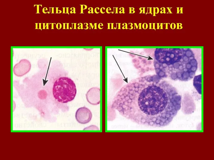 Тельца Рассела в ядрах и цитоплазме плазмоцитов