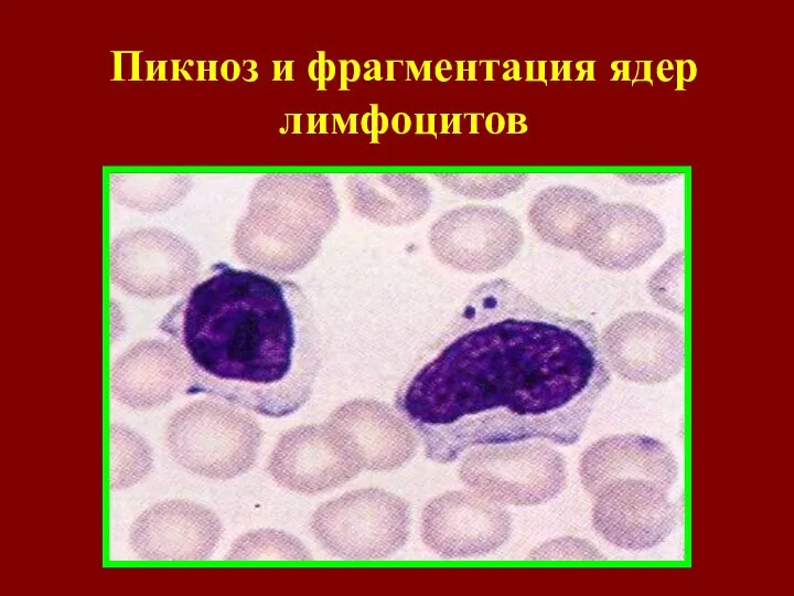 Пикноз и фрагментация ядер лимфоцитов