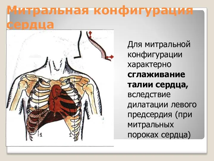 Митральная конфигурация сердца Для митральной конфигурации характерно сглаживание талии сердца, вследствие