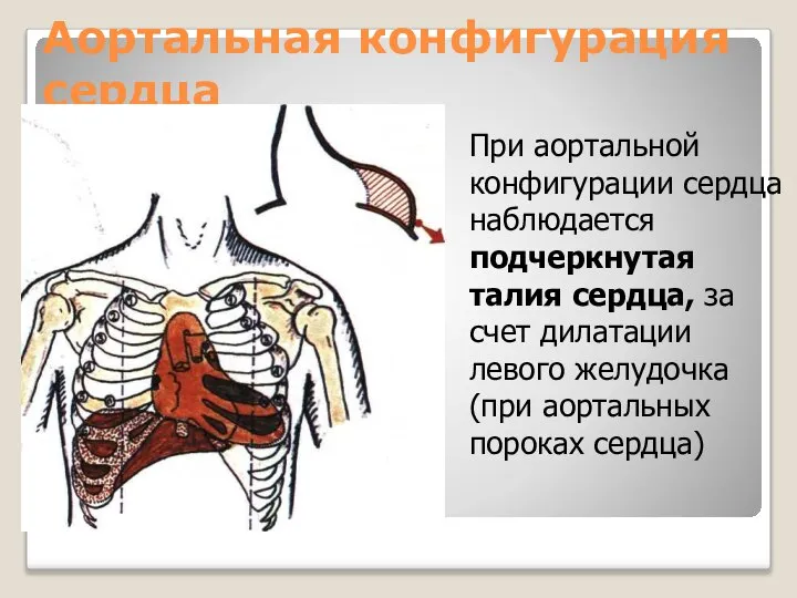 Аортальная конфигурация сердца При аортальной конфигурации сердца наблюдается подчеркнутая талия сердца,