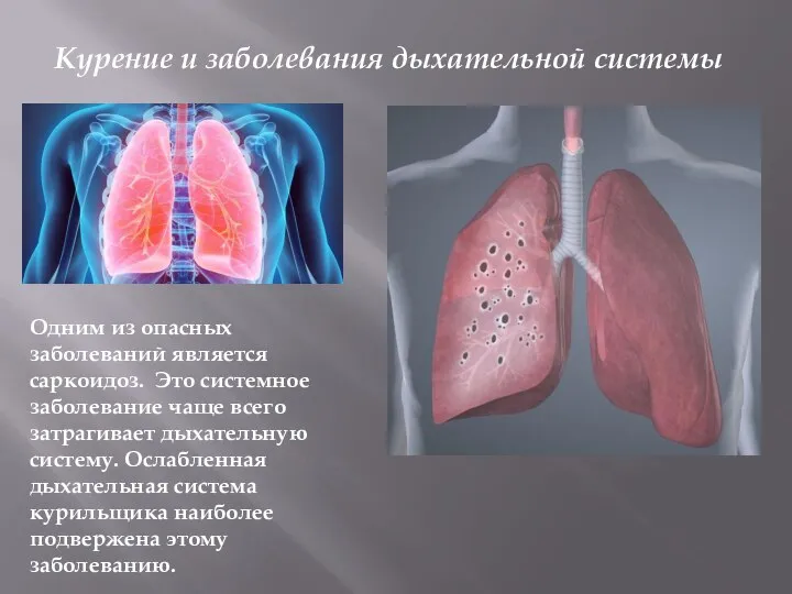 Одним из опасных заболеваний является саркоидоз. Это системное заболевание чаще всего