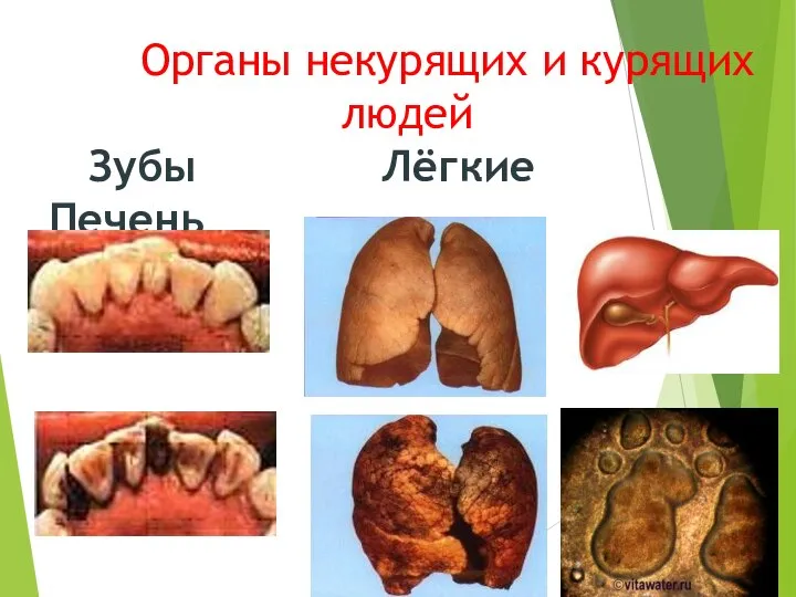 Органы некурящих и курящих людей Зубы Лёгкие Печень