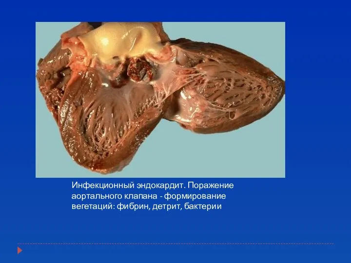 Инфекционный эндокардит. Поражение аортального клапана - формирование вегетаций: фибрин, детрит, бактерии