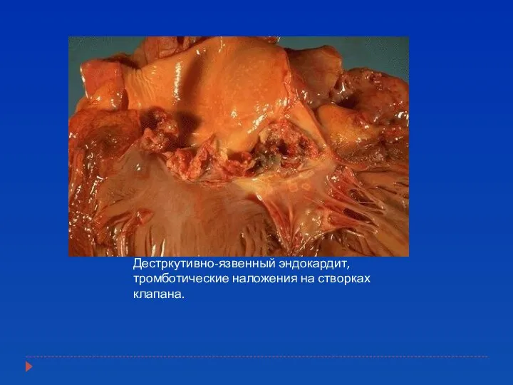 Дестркутивно-язвенный эндокардит, тромботические наложения на створках клапана.