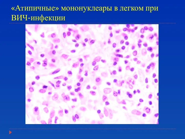 «Атипичные» мононуклеары в легком при ВИЧ-инфекции