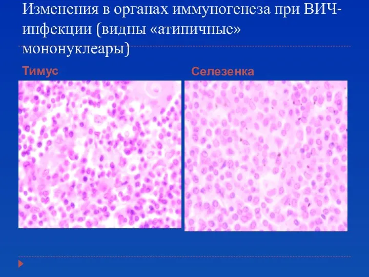 Изменения в органах иммуногенеза при ВИЧ-инфекции (видны «атипичные» мононуклеары) Тимус Селезенка