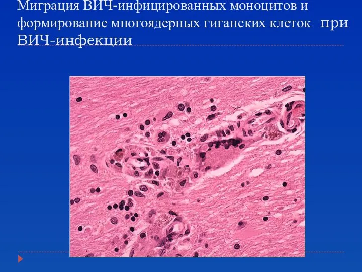 Миграция ВИЧ-инфицированных моноцитов и формирование многоядерных гиганских клеток при ВИЧ-инфекции