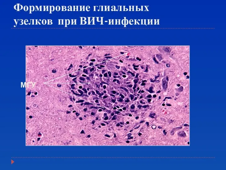 Формирование глиальных узелков при ВИЧ-инфекции MГУ