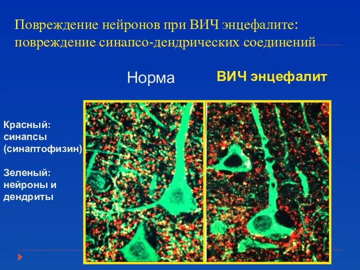 Повреждение нейронов при ВИЧ энцефалите: повреждение синапсо-дендрических соединений Норма ВИЧ энцефалит