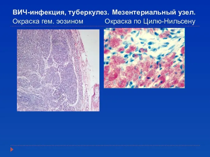 ВИЧ-инфекция, туберкулез. Мезентериальный узел. Окраска гем. эозином Окраска по Цилю-Нильсену