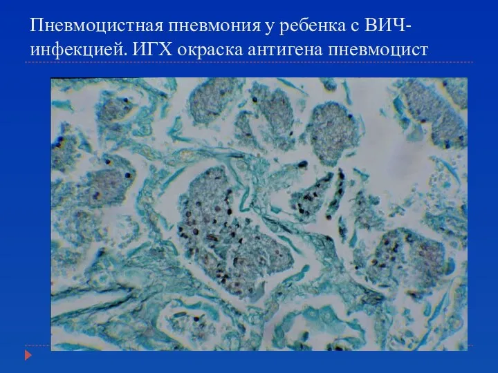 Пневмоцистная пневмония у ребенка с ВИЧ-инфекцией. ИГХ окраска антигена пневмоцист